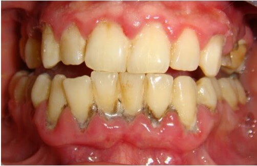 Biến chứng bệnh đái tháo đường tuýp 2