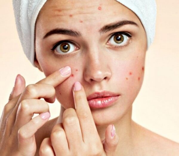 Ăn nhiều vú sữa có thể khiến bạn dễ nổi mụn