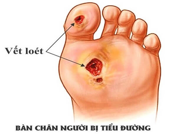Biến chứng bàn chân của bệnh tiểu đường