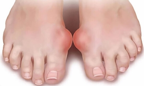 Thịt gà là một trong những loại thịt mà người bệnh gout có thể dùng