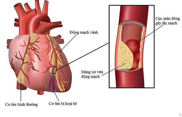 Bệnh mạch vành - Biến chứng tim mạch của bệnh tiểu đường