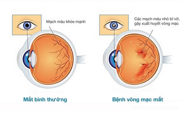 Bệnh võng mạc do đái tháo đường