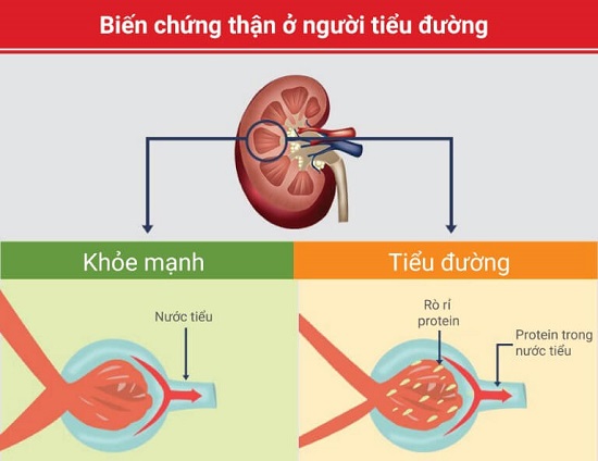 Biến chứng thận nguy hiểm