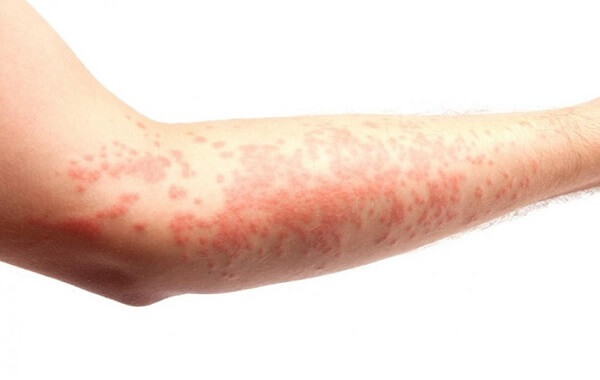 Có thể bị dị ứng khi ăn