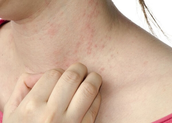 Một số người có thể bị dị ứng khi ăn đu đủ