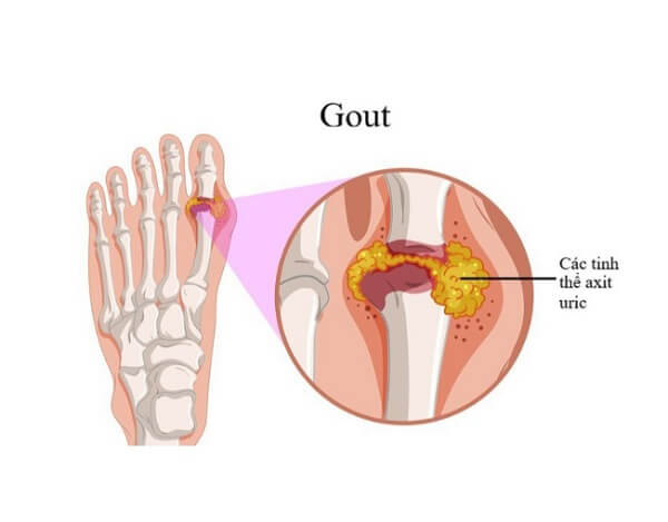 Hỗ trợ điều trị bệnh Gout