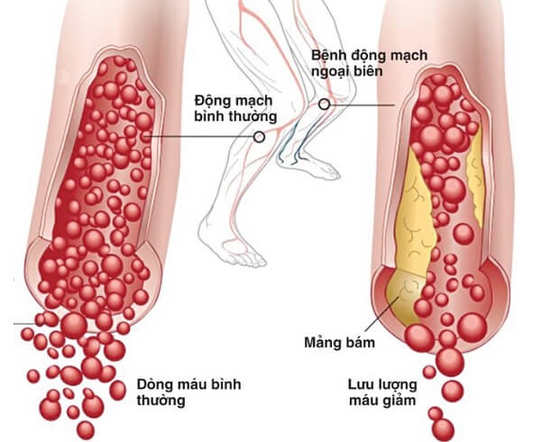 Nồng độ đường trong máu cao gây bệnh động mạch ngoại biên