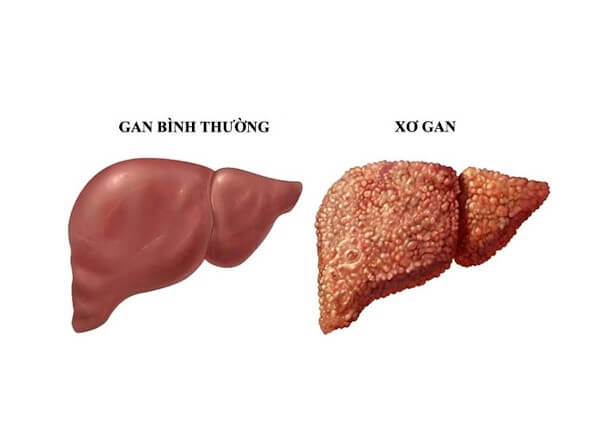 Đồ uống có cồn gây hại cho gan rất nghiêm trọng