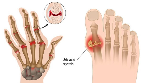 Làm trầm trọng thêm các triệu chứng của bệnh gout