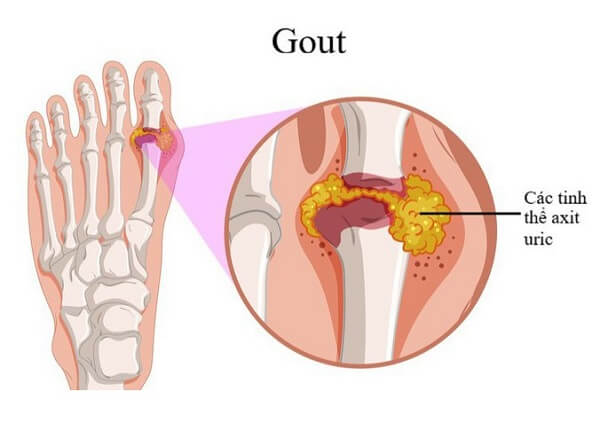 Người bệnh gout không nên sử dụng củ dền thường xuyên