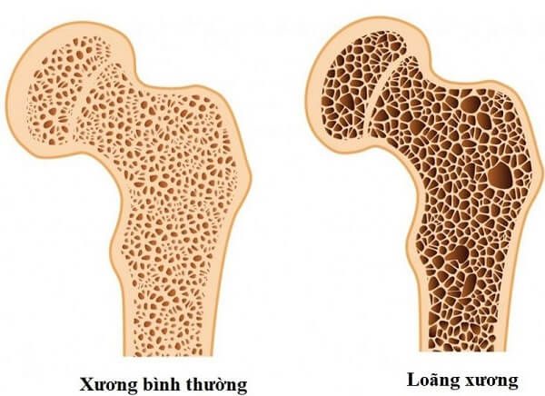 Dưa lê giúp tăng cường sức khỏe xương khớp