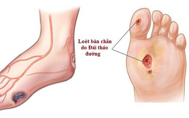 Bàn chân người bị tiểu đường