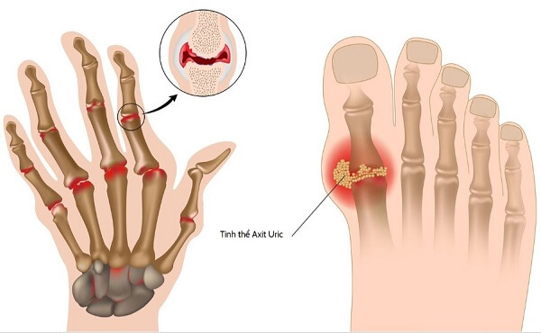 Rau ngót rất tốt cho người bệnh gout
