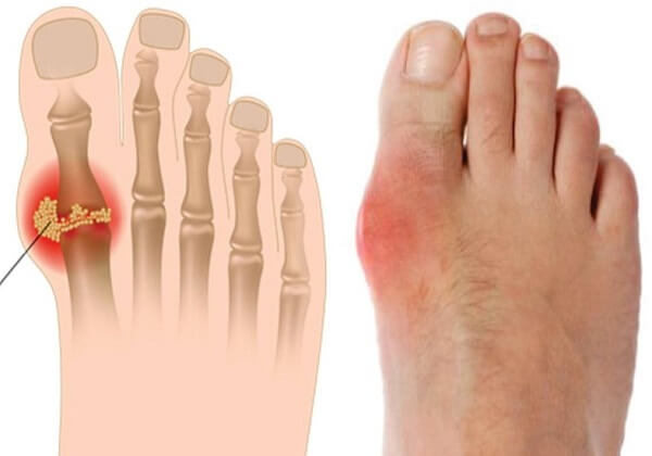 Người bệnh gout không nên sử dụng đậu phộng