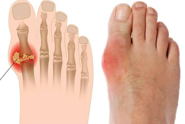 Người bệnh gout không nên ăn rau muống