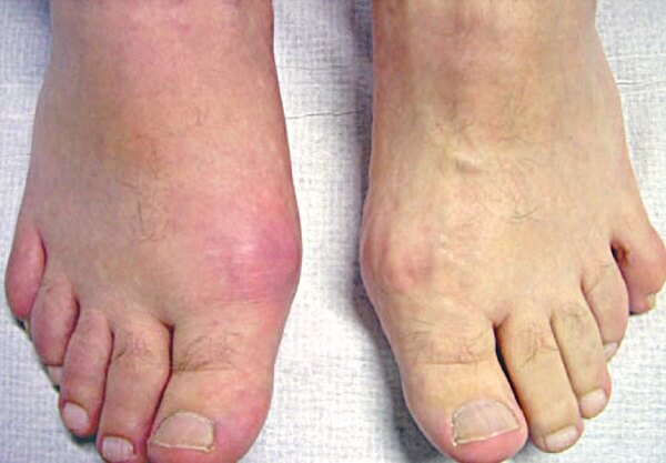 Người bệnh gout không nên ăn thịt vịt