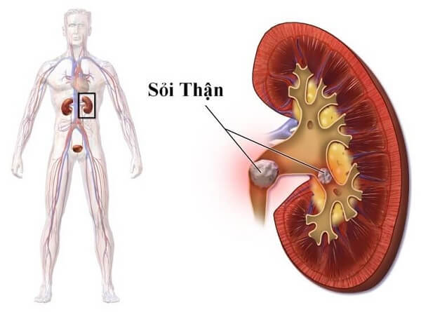 Người bệnh sỏi thận không nên ăn thịt gà