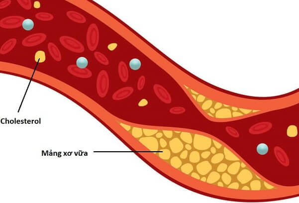 Nguyên nhân gây biến chứng tim mạch của người tiểu đường