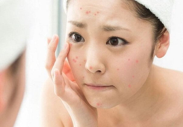 Lá ổi giúp trị mụn hiệu quả