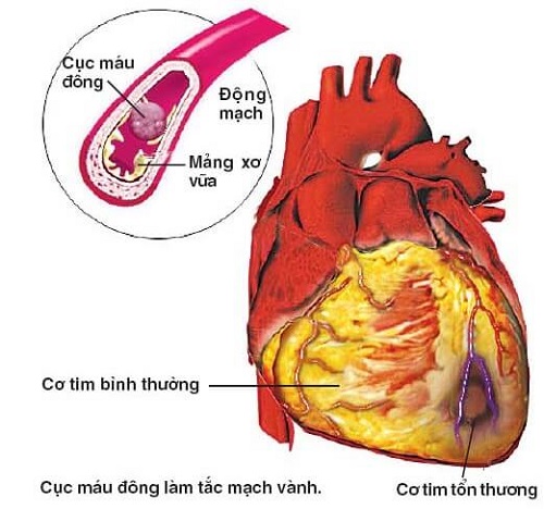 Xơ vữa động mạch - Biến chứng mạch máu lớn