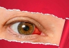 Biến chứng mắt bệnh tiểu đường nguy hiểm dẫn đến mù lòa